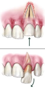 dislodged-tooth-155x300 dislodged-tooth-155x300